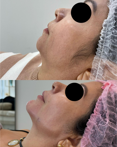 Antes x Depois