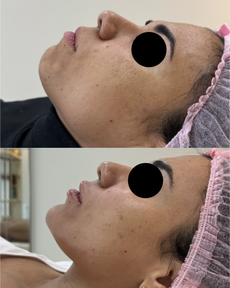 Antes x Depois